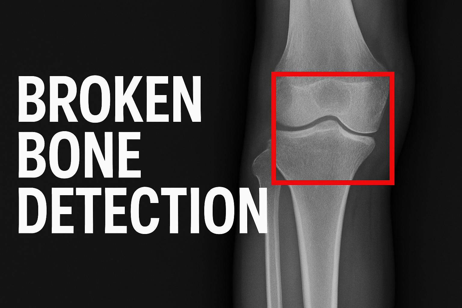 Broken Bone Detection